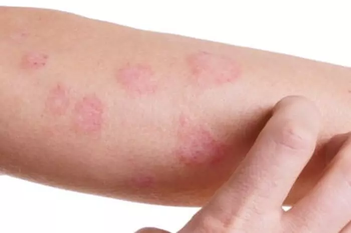Alergie pokarmowe jak zdiagnozować